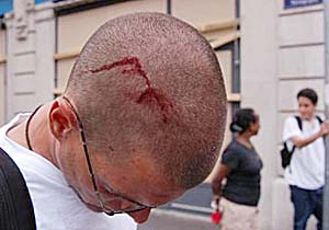 4. Head wound of brazilian journalist