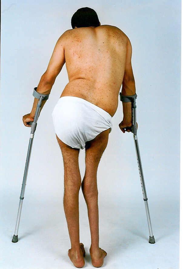 severe arthritis developed in detention