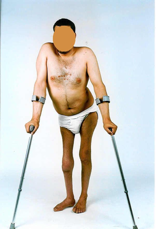 scars around his feet as he was hung by his feet with a rope