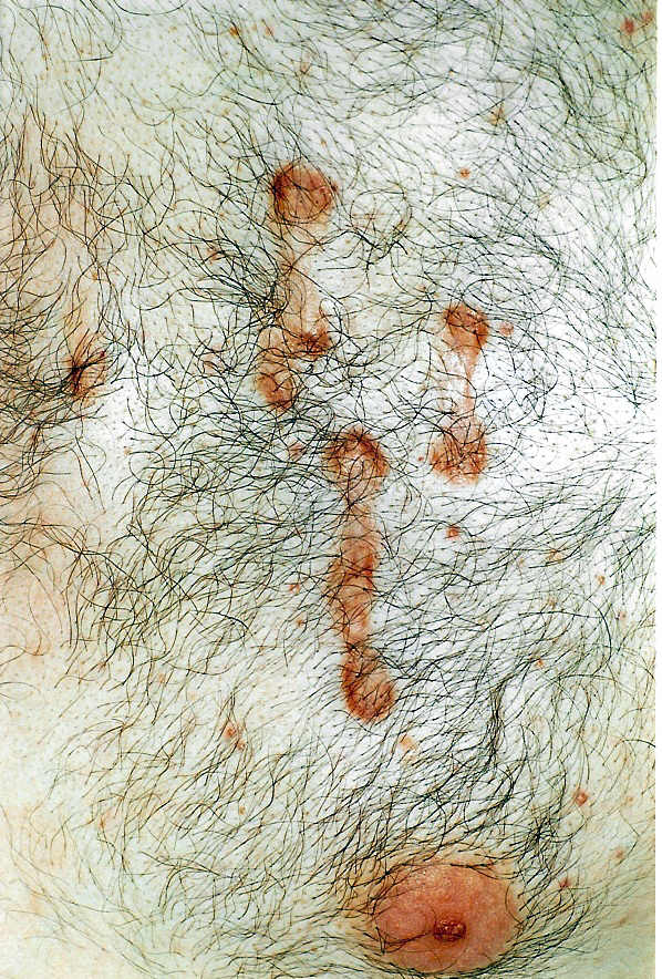 scars from a rash developed due to bad hygienic conditions in detention