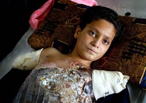 Ali Abbas survived but his entire family were burnt by the Americans