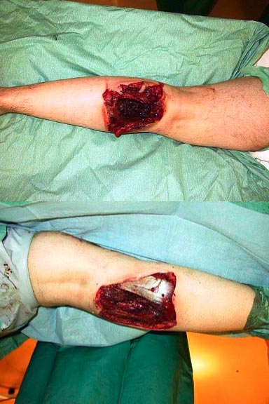 Guy Smallman's injured leg, Geneva 2003