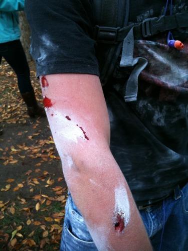 Rubber Bullet Wounds on at Occupy Denver