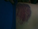 Bruise