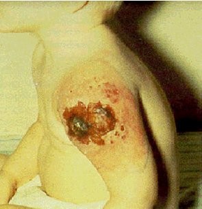 The effects of Smallpox vaccine - WARNING graphic photos