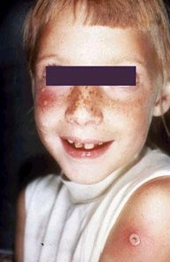 The effects of Smallpox vaccine - WARNING graphic photos