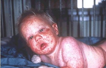 The effects of Smallpox vaccine - WARNING graphic photos