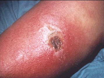 The effects of Smallpox vaccine - WARNING graphic photos