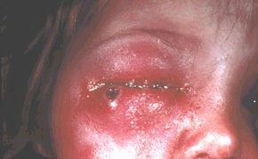 The effects of Smallpox vaccine - WARNING graphic photos