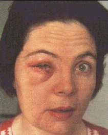 The effects of Smallpox vaccine - WARNING graphic photos