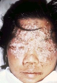 The effects of Smallpox vaccine - WARNING graphic photos