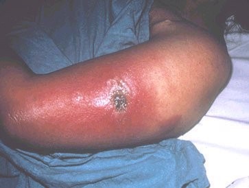 The effects of Smallpox vaccine - WARNING graphic photos
