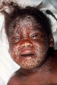 The effects of Smallpox vaccine - WARNING graphic photos