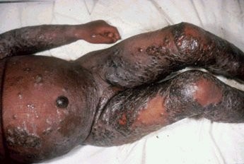 The effects of Smallpox vaccine - WARNING graphic photos