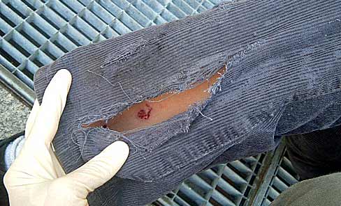 2.) tattered trouser, below lacerations & burns