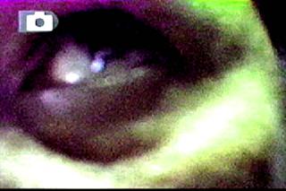 GAS PLASMA STRINGS ON LOWER LID/DEMON? ALIEN? ON RETINA?