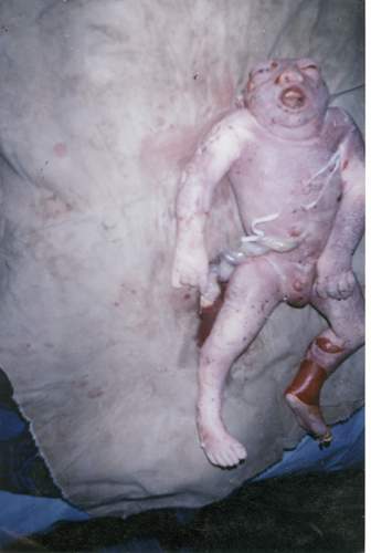 DEPLEATED URANIUM BABY