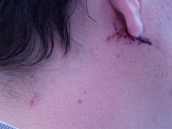 steve's neck nearly 40 hours after police assault