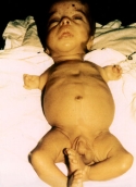Iraqi "Uranium Baby"
