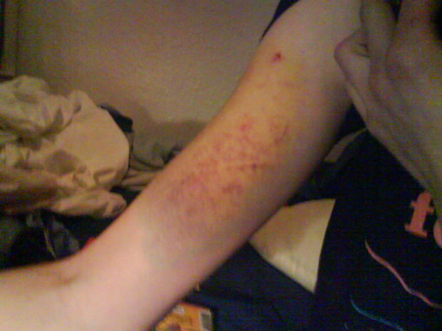 more bruises
