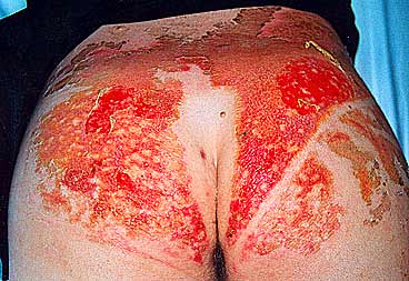 typical 'tear gas' acid burn day 10, zurich 2002