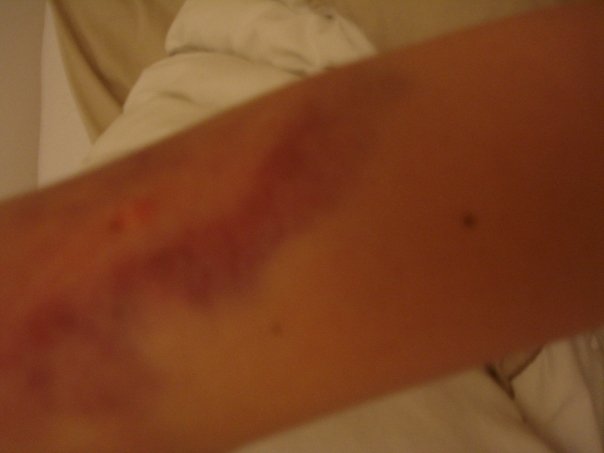 arm bruise given by policeman - no apparent reason, was just standing there!