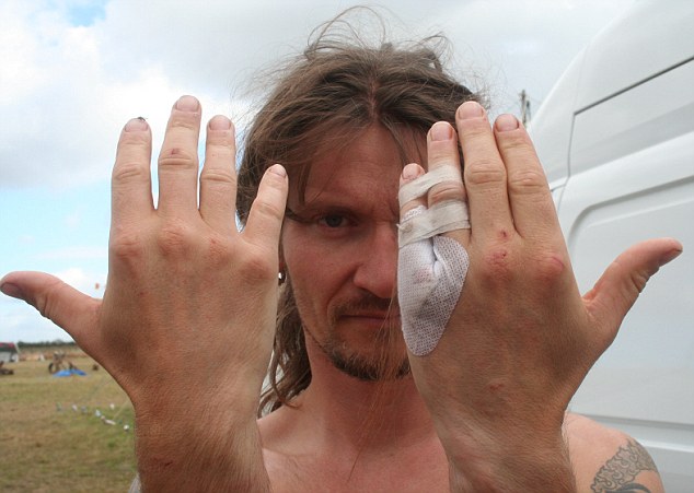 Mark Kennedy with broken finger