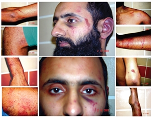 Some of Babars Injuries post police assault in December 2003
