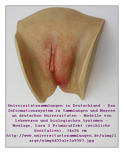 Moulage, Lues I Primäraffekt ....